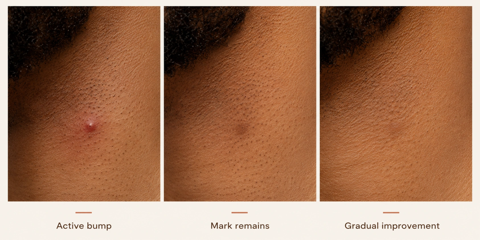 Three-stage illustration showing an active razor bump, a flattened bump with a lingering dark mark and gradual improvement in visible tone.